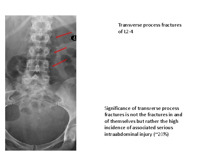 Transverse process fractures of L 2 -4 Significance of transverse process fractures is not