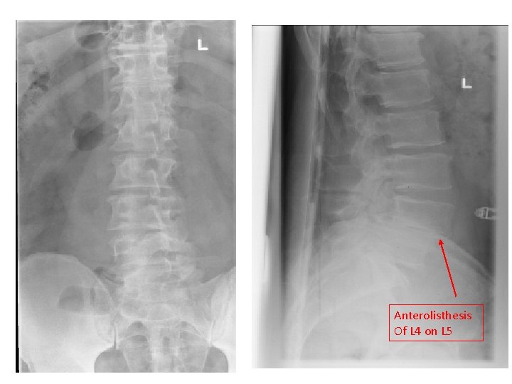 Anterolisthesis Of L 4 on L 5 