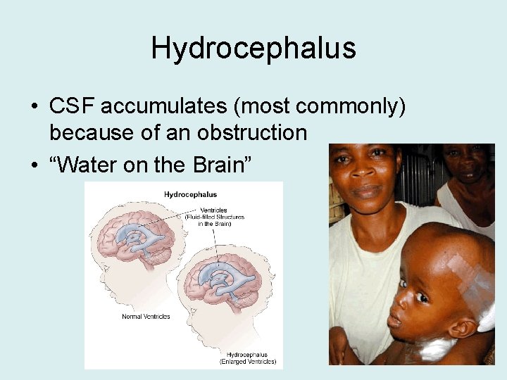 Hydrocephalus • CSF accumulates (most commonly) because of an obstruction • “Water on the