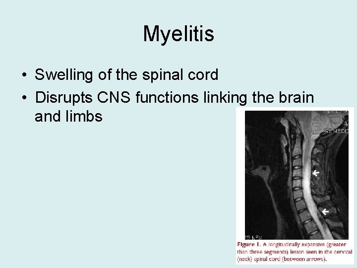 Myelitis • Swelling of the spinal cord • Disrupts CNS functions linking the brain