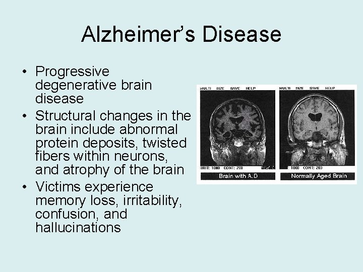 Alzheimer’s Disease • Progressive degenerative brain disease • Structural changes in the brain include