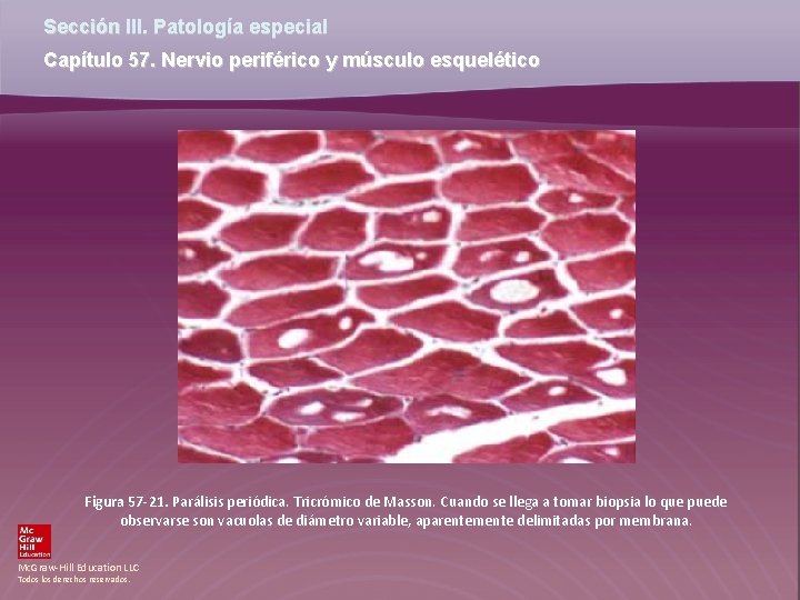 Sección III. Patología especial Capítulo 57. Nervio periférico y músculo esquelético Figura 57 -21.