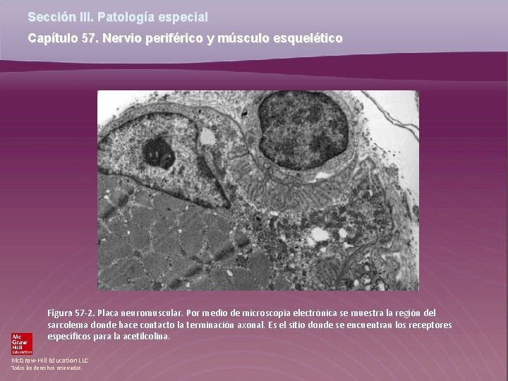 Sección III. Patología especial Capítulo 57. Nervio periférico y músculo esquelético Figura 57 -2.