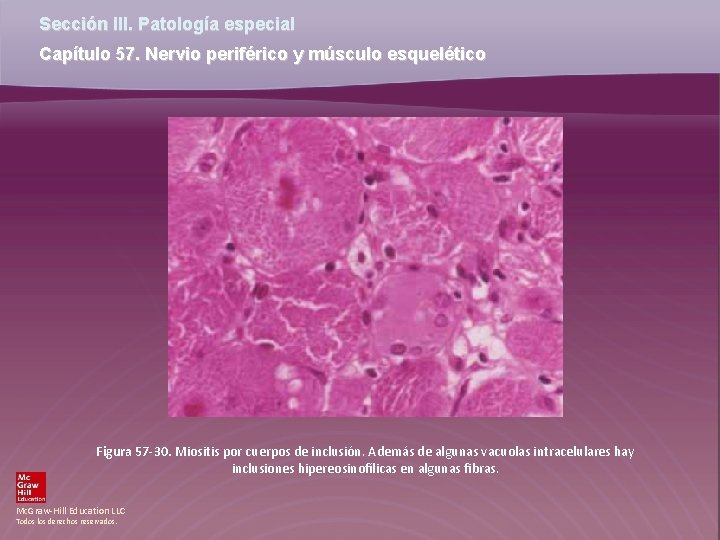 Sección III. Patología especial Capítulo 57. Nervio periférico y músculo esquelético Figura 57 -30.