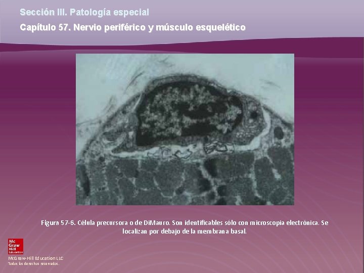 Sección III. Patología especial Capítulo 57. Nervio periférico y músculo esquelético Figura 57 -6.