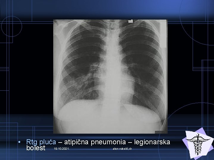  • Rtg pluća – atipična pneumonia – legionarska alen vukelić, dr bolest 19.