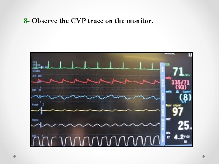 8 - Observe the CVP trace on the monitor. 