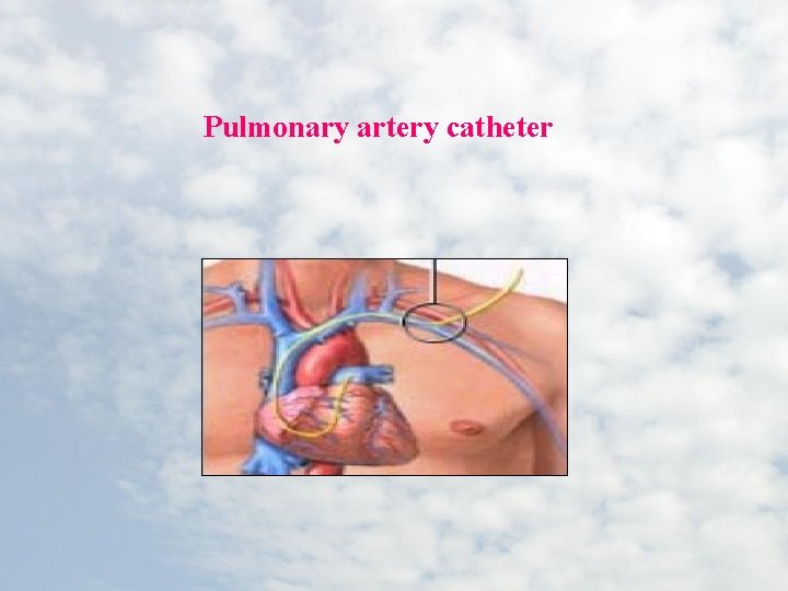 Pulmonary artery catheter 