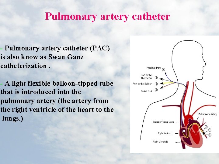 Pulmonary artery catheter - Pulmonary artery catheter (PAC) is also know as Swan Ganz