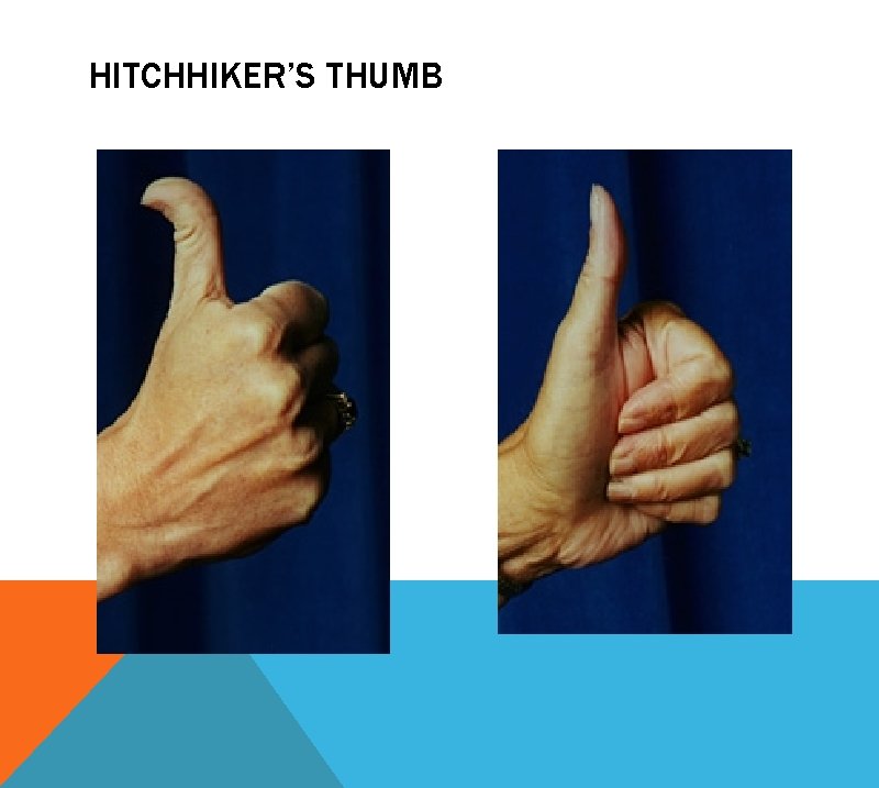 HITCHHIKER’S THUMB 