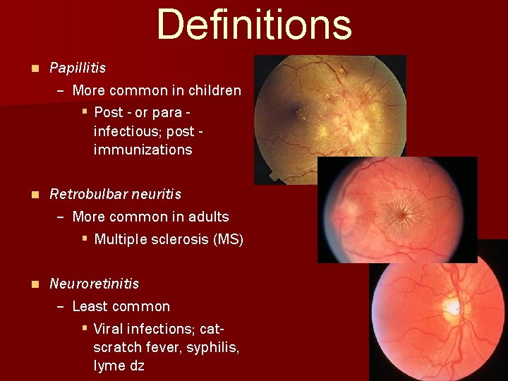 Definitions n Papillitis – More common in children § Post - or para infectious;