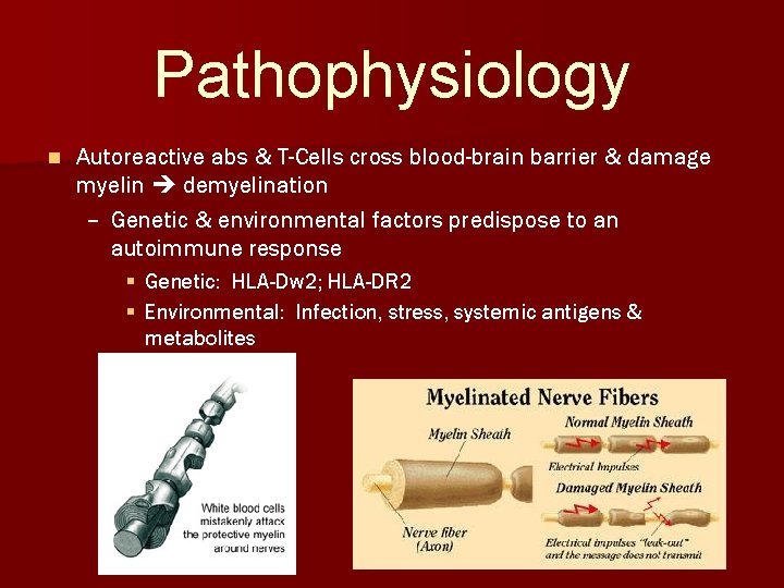 Pathophysiology n Autoreactive abs & T-Cells cross blood-brain barrier & damage myelin demyelination –