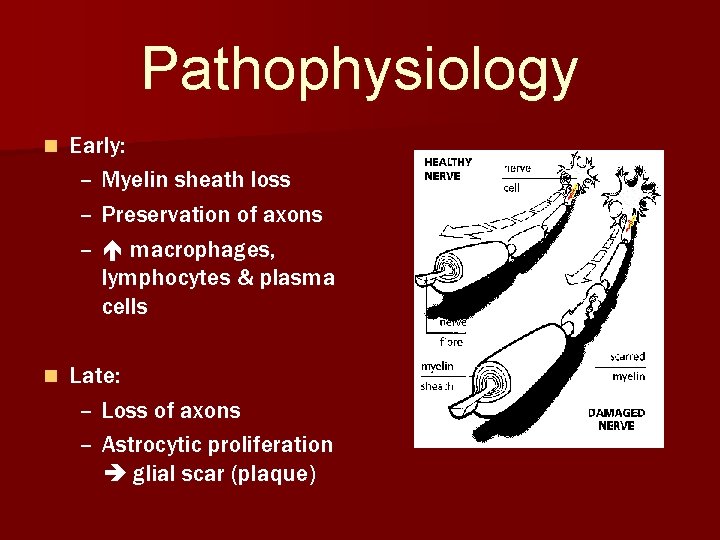 Pathophysiology n Early: – Myelin sheath loss – Preservation of axons – macrophages, lymphocytes