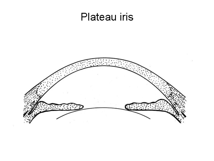 Plateau iris 