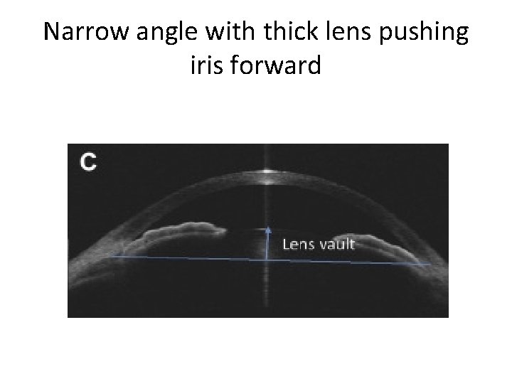 Narrow angle with thick lens pushing iris forward 