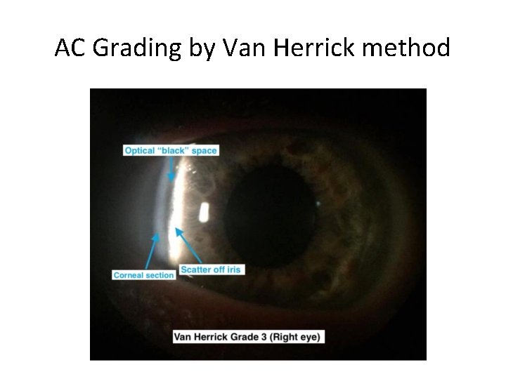 AC Grading by Van Herrick method 