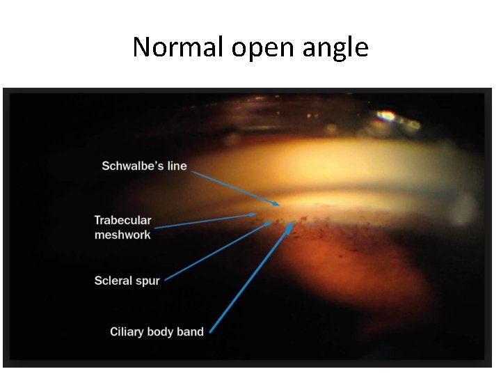 Normal open angle 