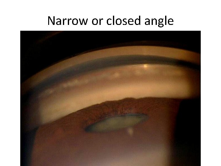 Narrow or closed angle 