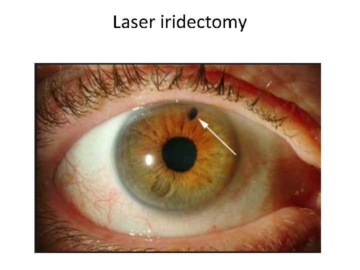 Laser iridectomy 