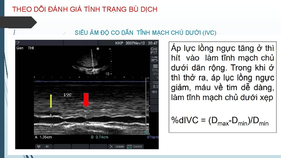 THEO DÕI ĐÁNH GIÁ TÌNH TRẠNG BÙ DỊCH SIÊU M ĐỘ CO DÃN TĨNH