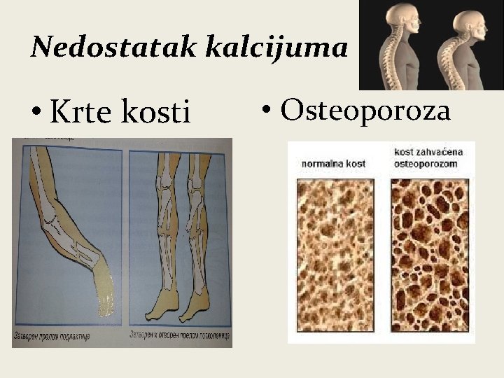 Nedostatak kalcijuma • Krte kosti • Osteoporoza 