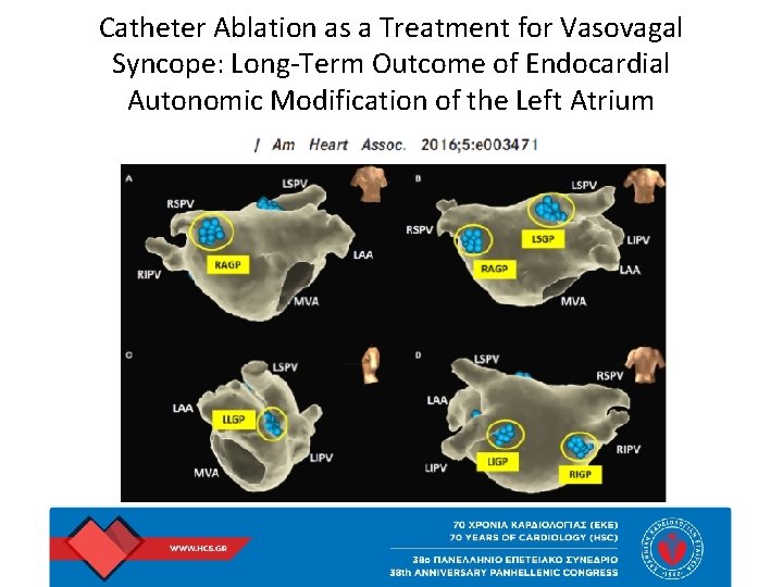 Catheter Ablation as a Treatment for Vasovagal Syncope: Long-Term Outcome of Endocardial Autonomic Modification