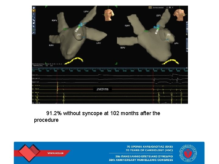 91. 2% without syncope at 102 months after the procedure 