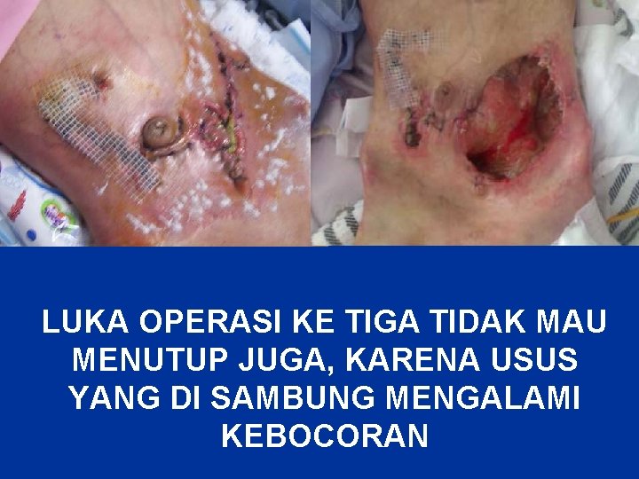 LUKA OPERASI KE TIGA TIDAK MAU MENUTUP JUGA, KARENA USUS YANG DI SAMBUNG MENGALAMI