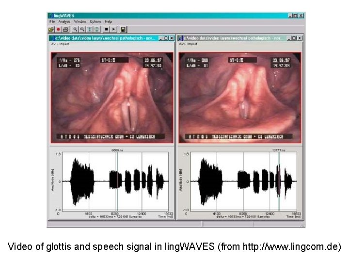 Video of glottis and speech signal in ling. WAVES (from http: //www. lingcom. de)