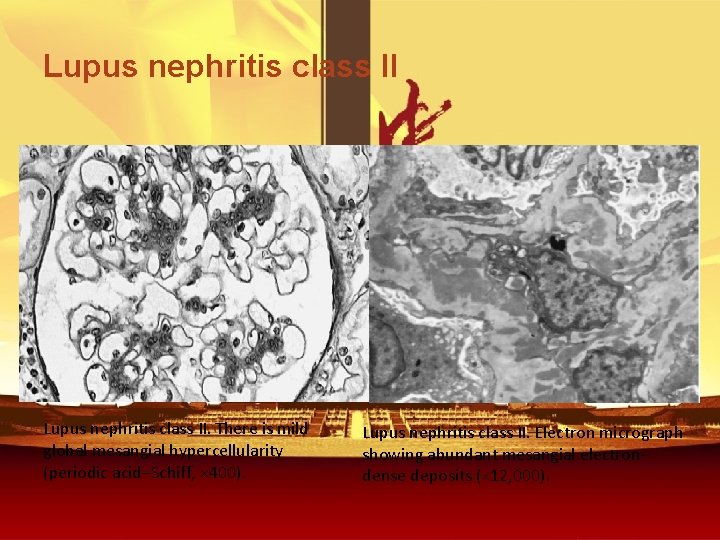 Lupus nephritis class II. There is mild global mesangial hypercellularity (periodic acid–Schiff, × 400).