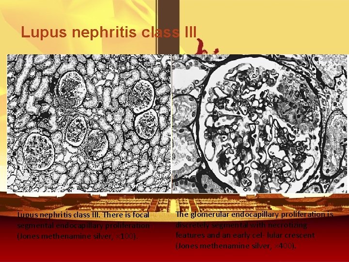 Lupus nephritis class III. There is focal segmental endocapillary proliferation (Jones methenamine silver, ×