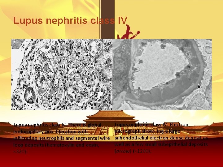 Lupus nephritis class IV. There is global endocapillary pro- liferation with infiltrating neutrophils and