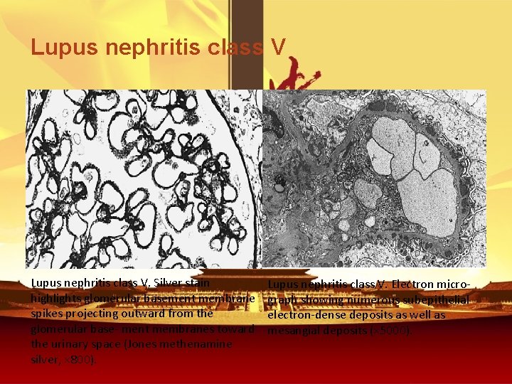 Lupus nephritis class V. Silver stain highlights glomerular basement membrane spikes projecting outward from