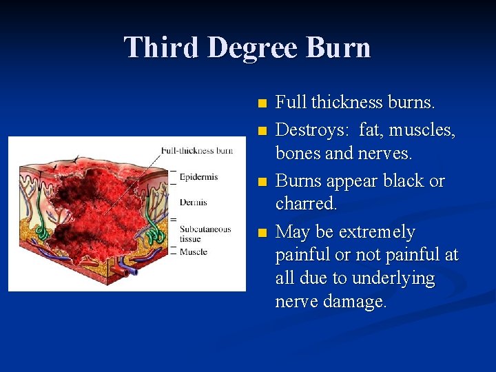 Third Degree Burn n n Full thickness burns. Destroys: fat, muscles, bones and nerves.