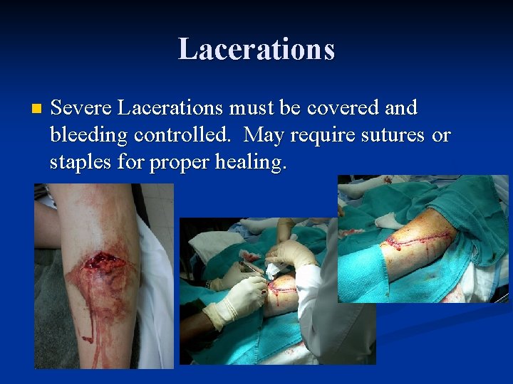 Lacerations n Severe Lacerations must be covered and bleeding controlled. May require sutures or