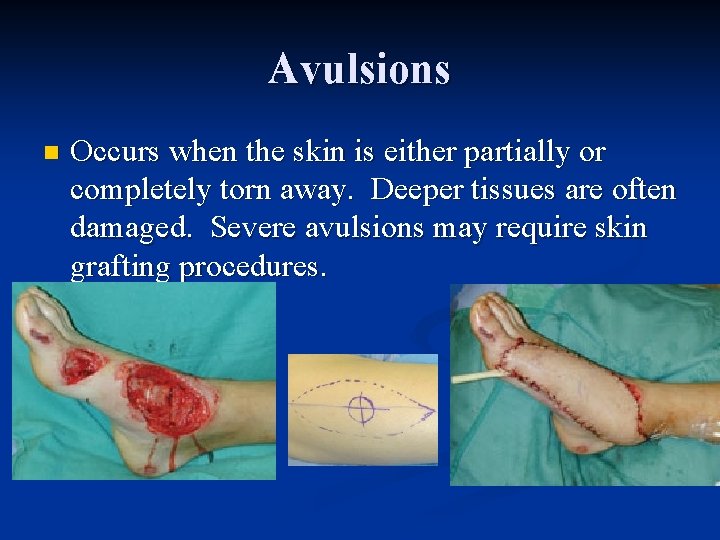 Avulsions n Occurs when the skin is either partially or completely torn away. Deeper