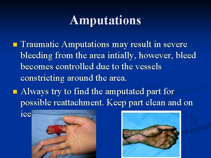 Amputations Traumatic Amputations may result in severe bleeding from the area intially, however, bleed