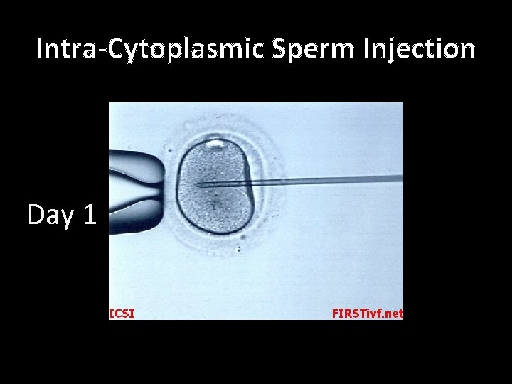 Intra-Cytoplasmic Sperm Injection Day 1 