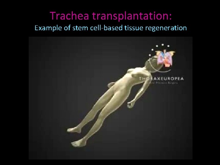 Trachea transplantation: Example of stem cell-based tissue regeneration 