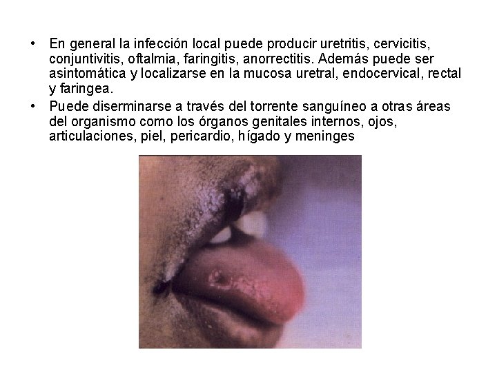  • En general la infección local puede producir uretritis, cervicitis, conjuntivitis, oftalmia, faringitis,