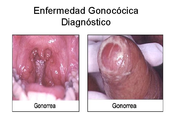 Enfermedad Gonocócica Diagnóstico 