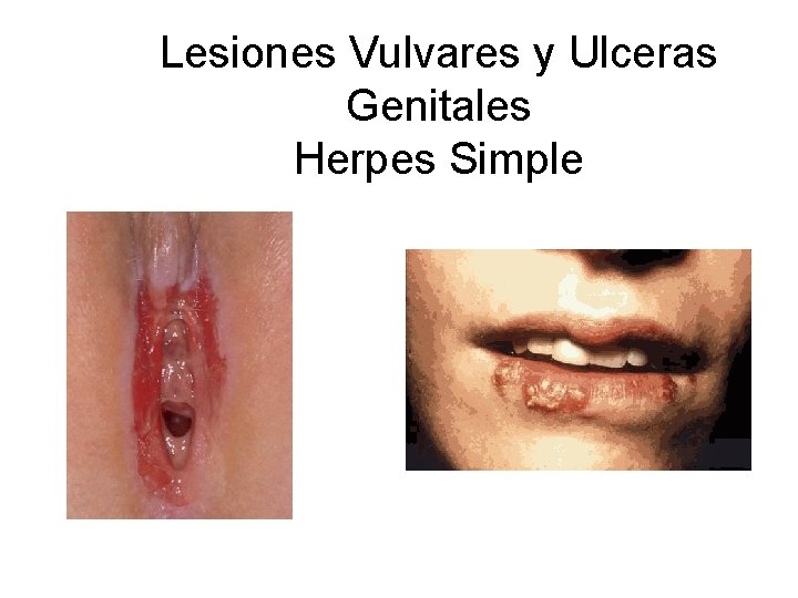 Lesiones Vulvares y Ulceras Genitales Herpes Simple 