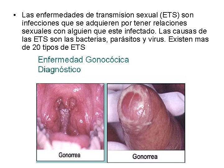  • Las enfermedades de transmision sexual (ETS) son infecciones que se adquieren por