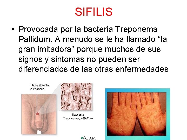 SIFILIS • Provocada por la bacteria Treponema Pallidum. A menudo se le ha llamado
