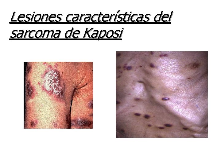 Lesiones características del sarcoma de Kaposi Lesiones características del sarcoma de Kaposi
