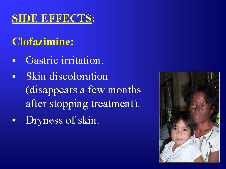 SIDE EFFECTS: Clofazimine: • Gastric irritation. • Skin discoloration (disappears a few months after