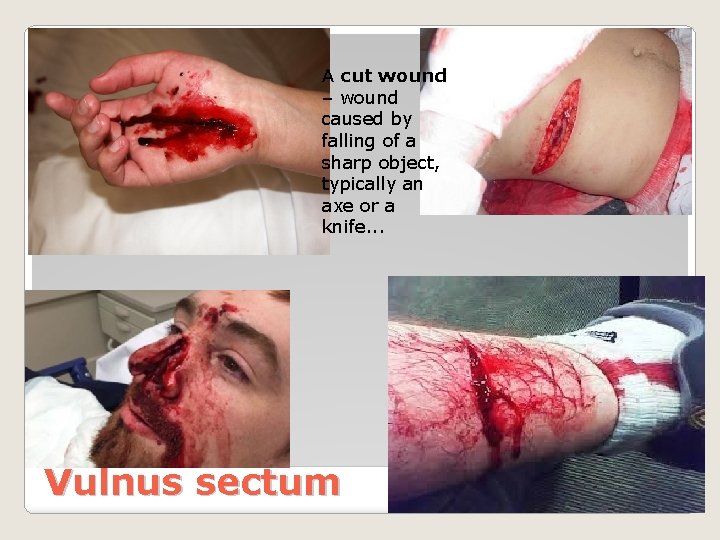 A cut wound – wound caused by falling of a sharp object, typically an
