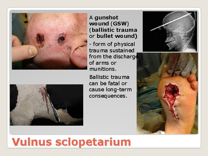 A gunshot wound (GSW) (ballistic trauma or bullet wound) - form of physical trauma