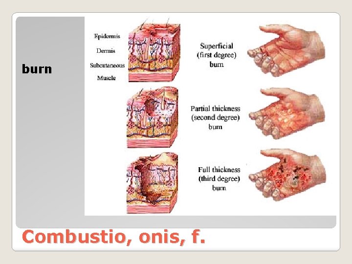 burn Combustio, onis, f. 