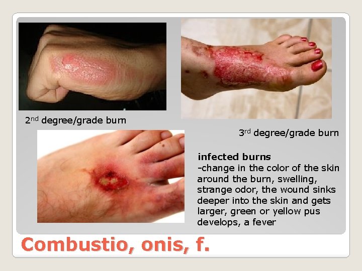 2 nd degree/grade burn 3 rd degree/grade burn infected burns -change in the color